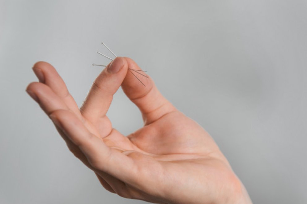 Acupuncture Pin - Stuart Community